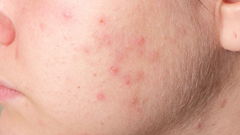 Haut an Wange mit Akne