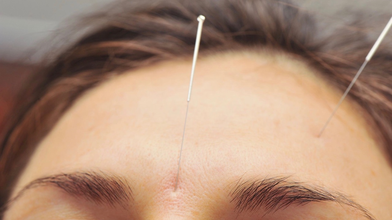 Akupunkturnadeln stecken im vorderen Stirnbereich einer Frau